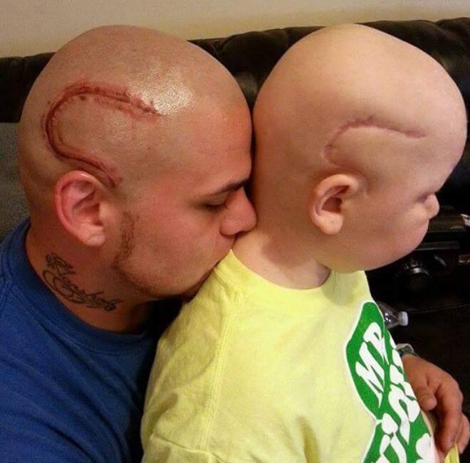 Den lille pojken kände sig som ett monster efter canceroperationen i huvudet – då gjorde hand pappa det rätta