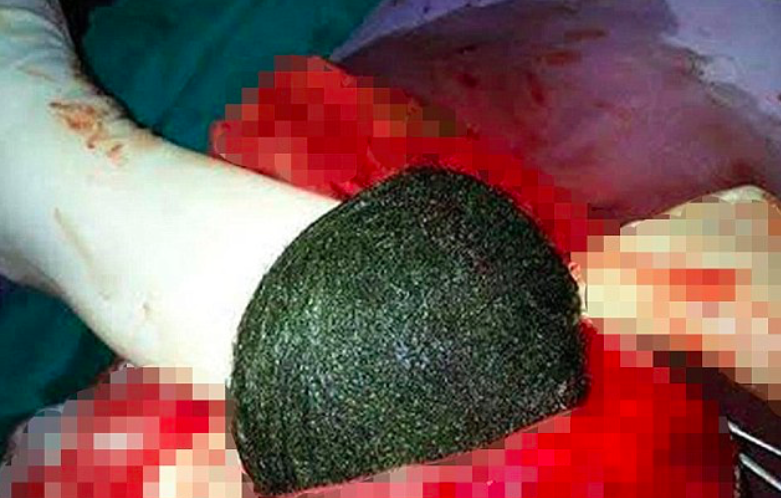 38-årig hade problem med att äta och dricka: Läkarna sövde ner henne och hittade denna klump