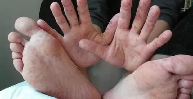 Varning för virus-epidemi: Föräldrar bör känna till dessa symptom