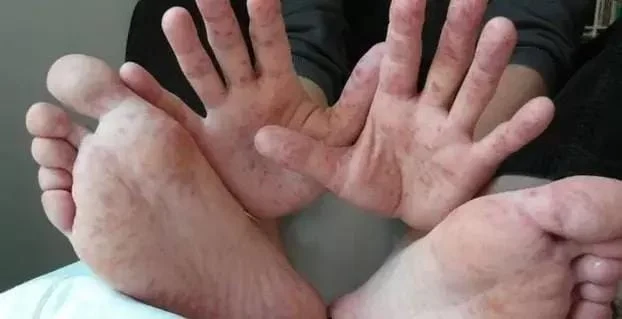 Varning för virus-epidemi: Föräldrar bör känna till dessa symptom