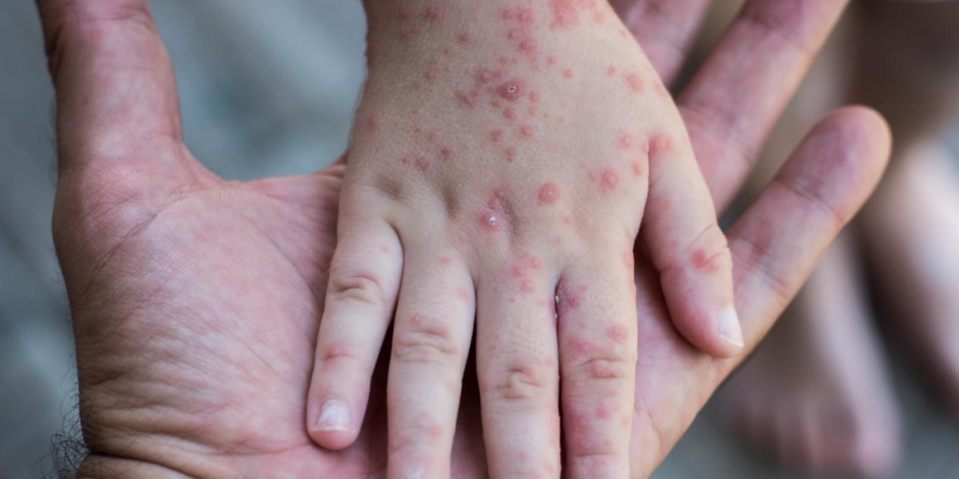Snabb spridning av ny dödlig mpox-variant i Afrika väcker global oro