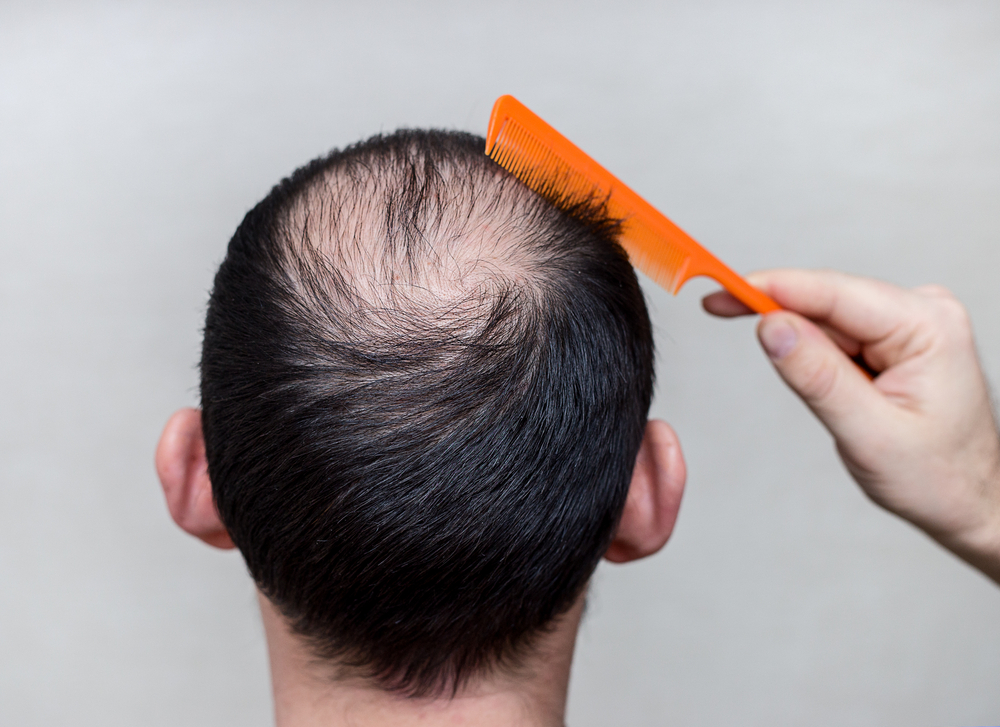 Botemedel mot alopeci?