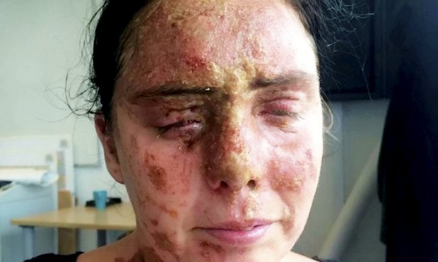 Bröderna kastade syra i ansiktet på Carla och förstörde hennes liv: därför gjorde de det