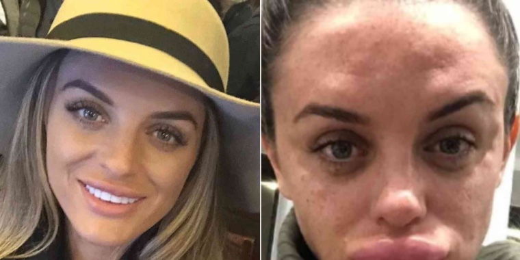 29-årig kvinna fick fillers i läpparna: Nu visar hon hur fel det kan gå