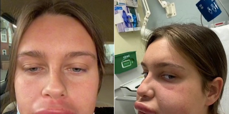 Kvinna inlagd på sjukhus: Blev helt fel då hon ville ta bort fillers