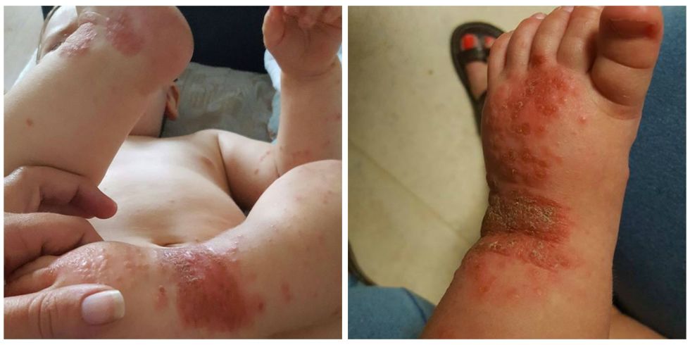 Mammans skrämmande bilder av Oliver blir virala: Tänk dig för innan du pussar din bebis