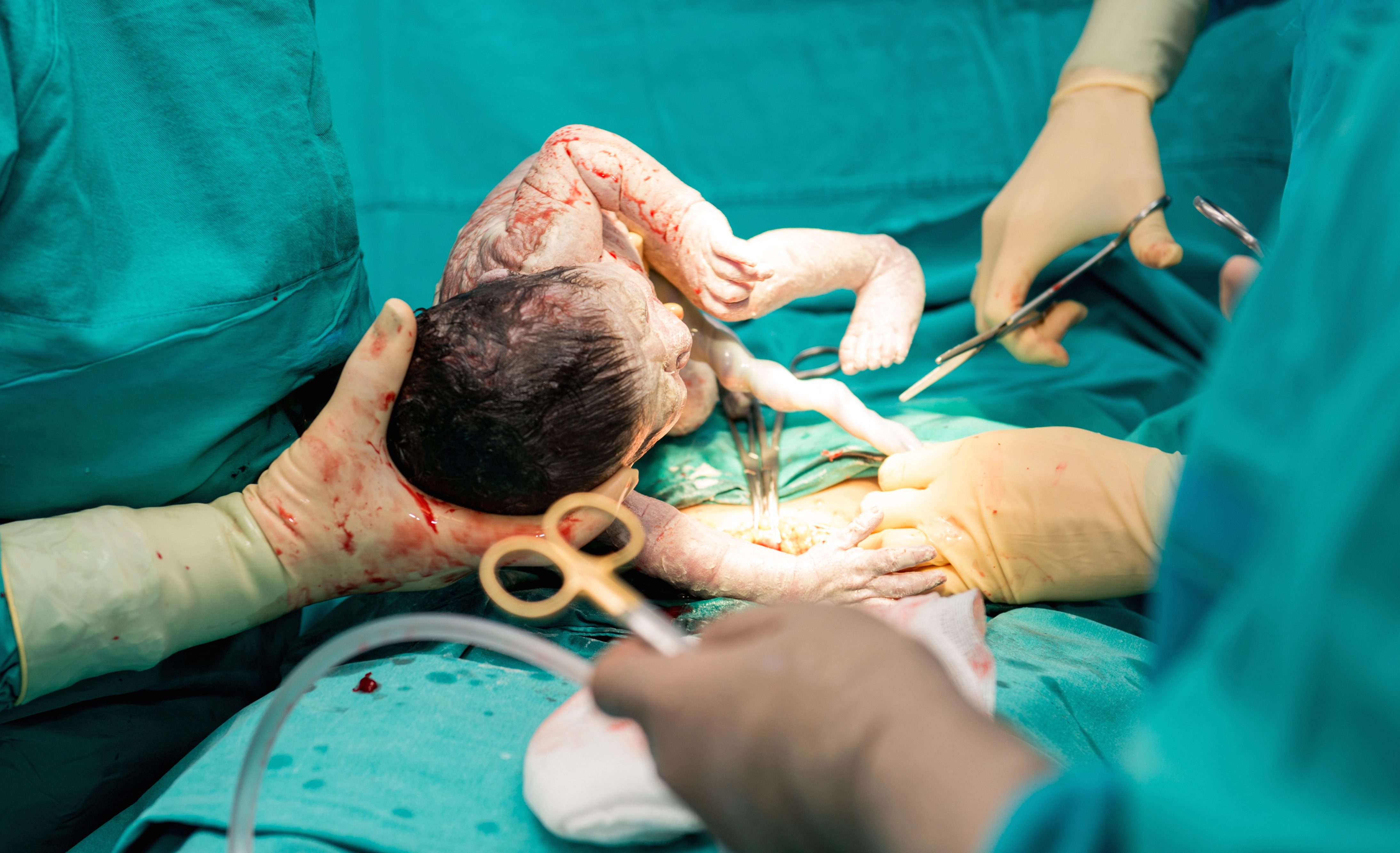 Ofödd baby blir skuren i ansiktet under kejsarsnitt – får ärr för livet