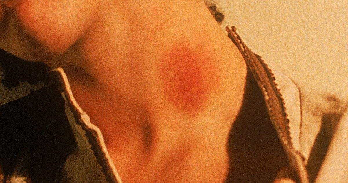 Hon gav sin pojkvän ett sugmärke på halsen – senare på kvällen dog han av en stroke