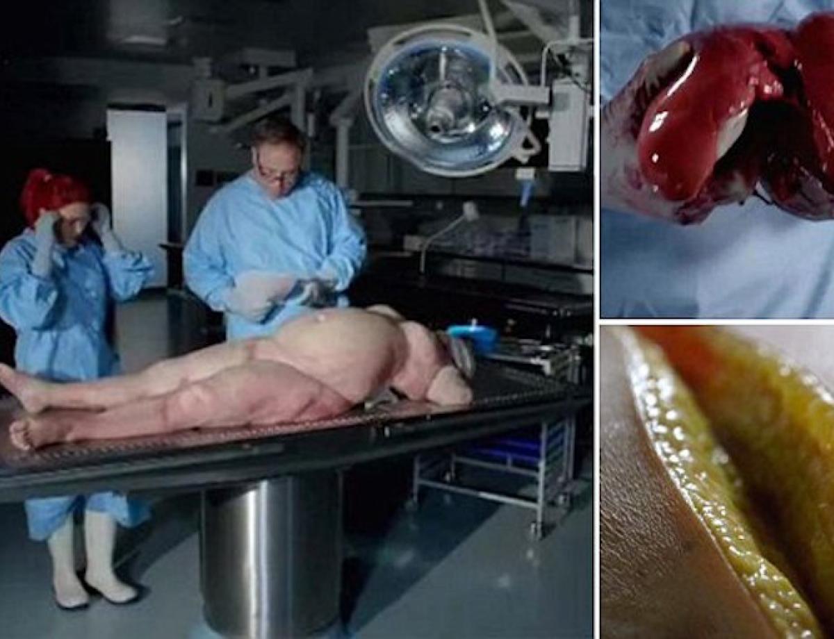 BBC-dokumentär avslöjar vad som gömmer sig i kroppen på en överviktig person