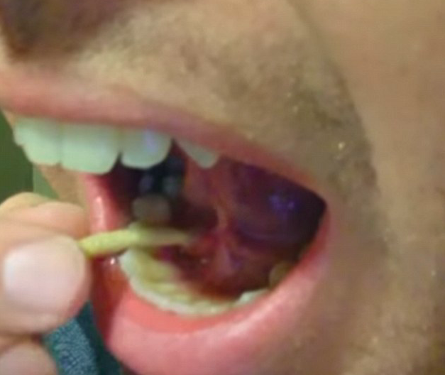 Mans video av lång spottsten i munnen ses av tusentals på nätet
