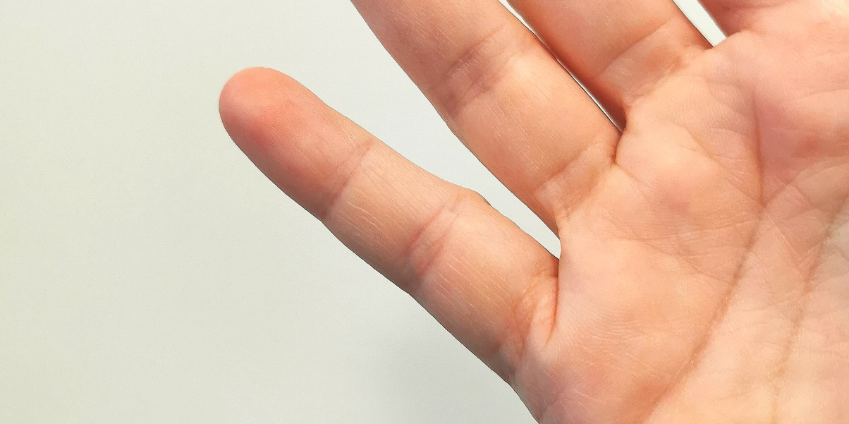 Din smartphone kan orsaka permanent skada på ditt lillfinger: Känn efter själv