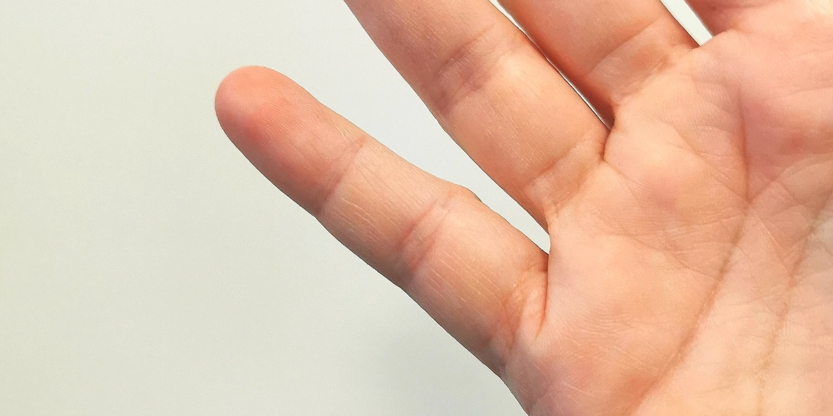 Din smartphone kan orsaka permanent skada på ditt lillfinger: Känn efter själv