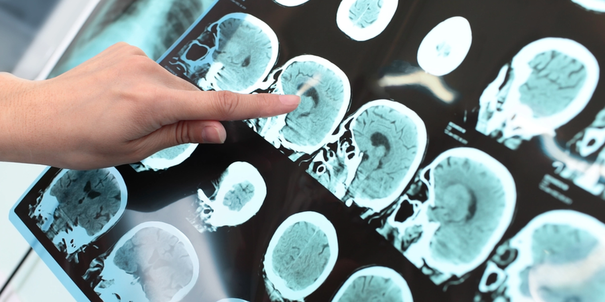 Så kan simning skydda din hjärna mot Alzheimers, enligt läkare