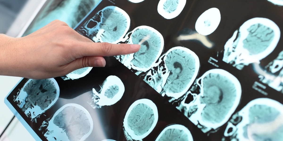 Så kan simning skydda din hjärna mot Alzheimers, enligt läkare