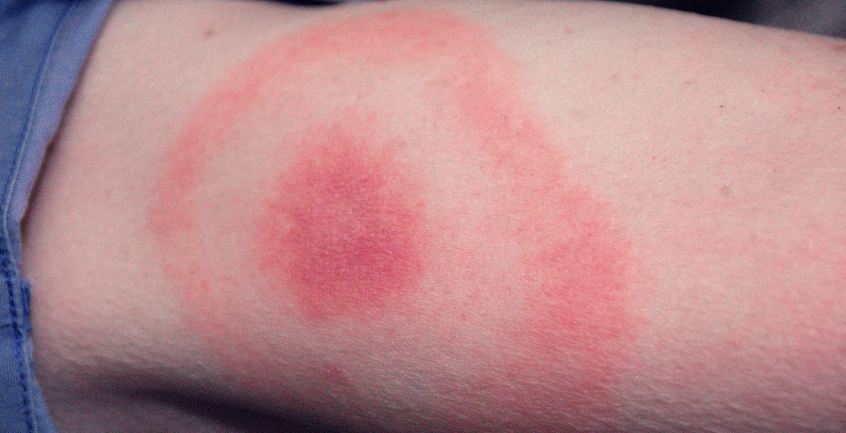 Förebygg borrelia: Så minskar du risken för fästingöverförda sjukdomar
