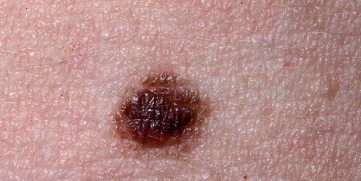 Banbrytande algoritm revolutionerar hudcancerdiagnos