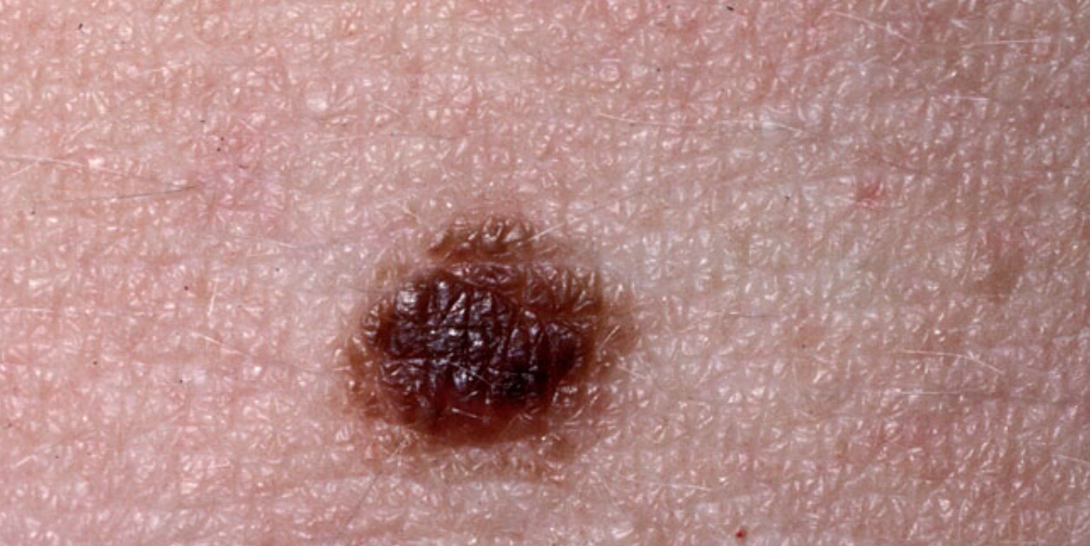 Banbrytande algoritm revolutionerar hudcancerdiagnos