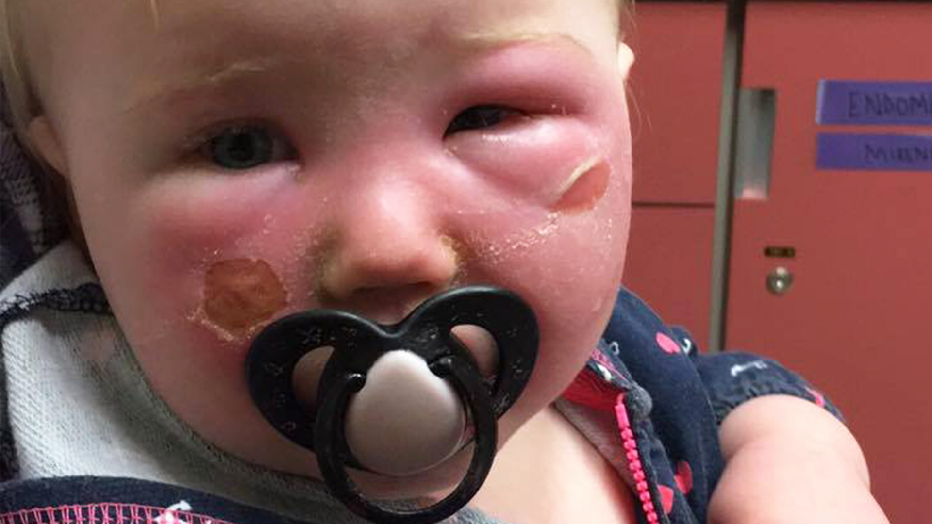 Rebecca varnar för solkrämen, efter att hennes 14 månader gamla dotter hamnade på sjukhuset