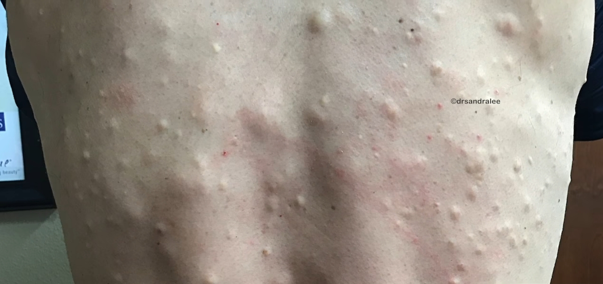 Han går till läkaren med ryggen täckt av knölar, men vänta tills hon skär hål på dem